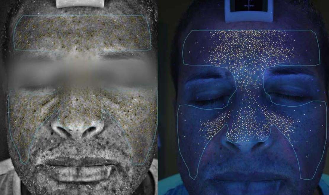 Digital facial skin analysis