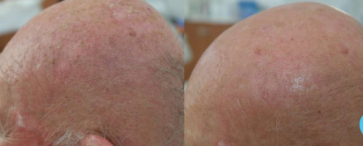 Treatment of precancerous skin cancer – photodynamic therapy