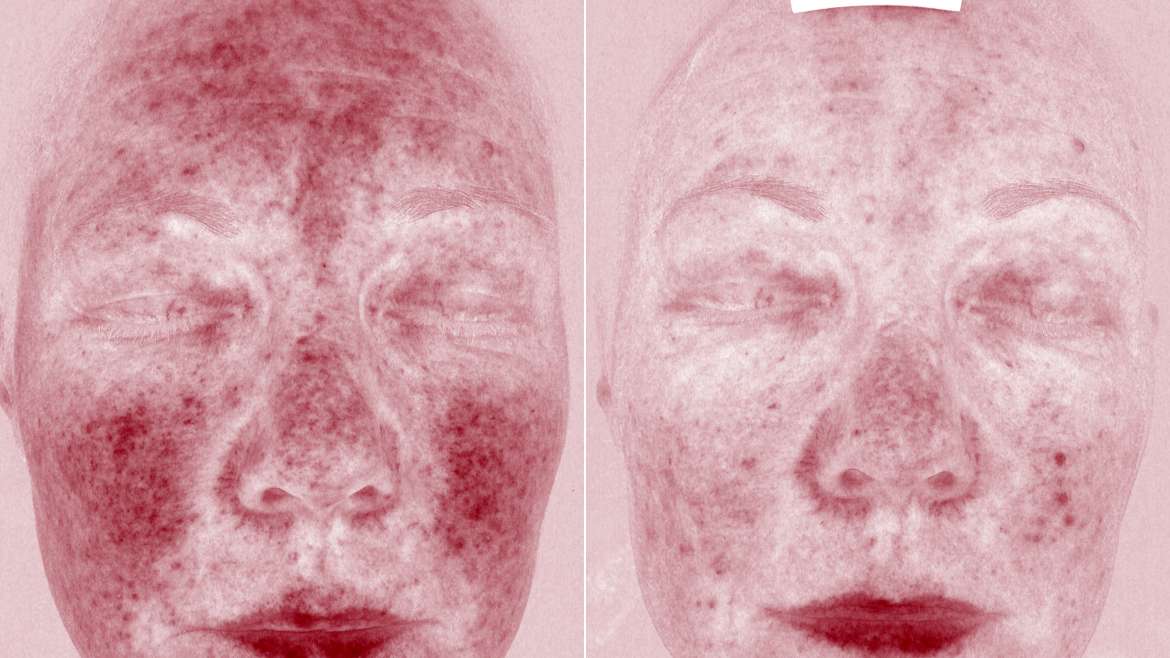 Treatment of redness, rosacea and laser vein removal