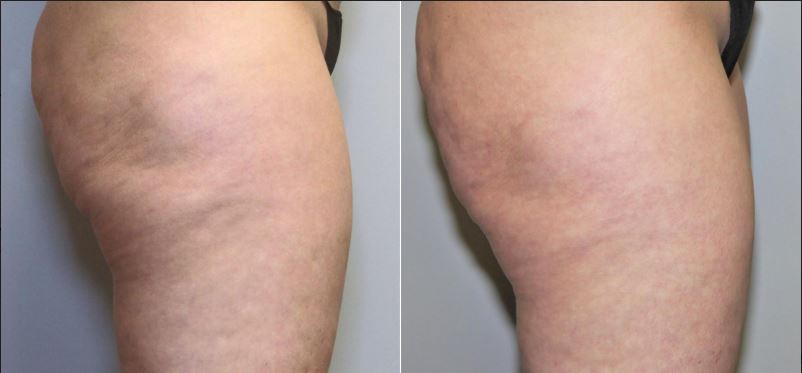 Profound – Cellulite