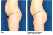 VelaShape III.