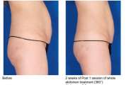 VelaShape III.