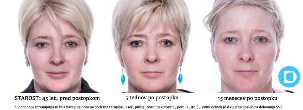 Pomlajevanje kože s stromalnimi matičnimi celicami