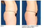 VelaShape III.
