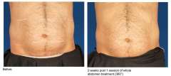 VelaShape III.