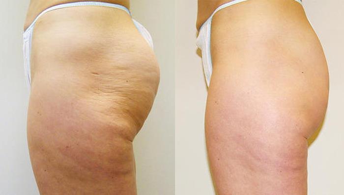 VelaShape® III