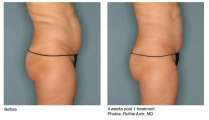 VelaShape III.