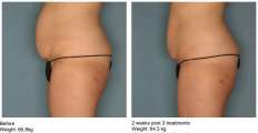 VelaShape III.