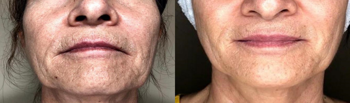 GOURI – liquid collagen stimulator with polycarprolactone