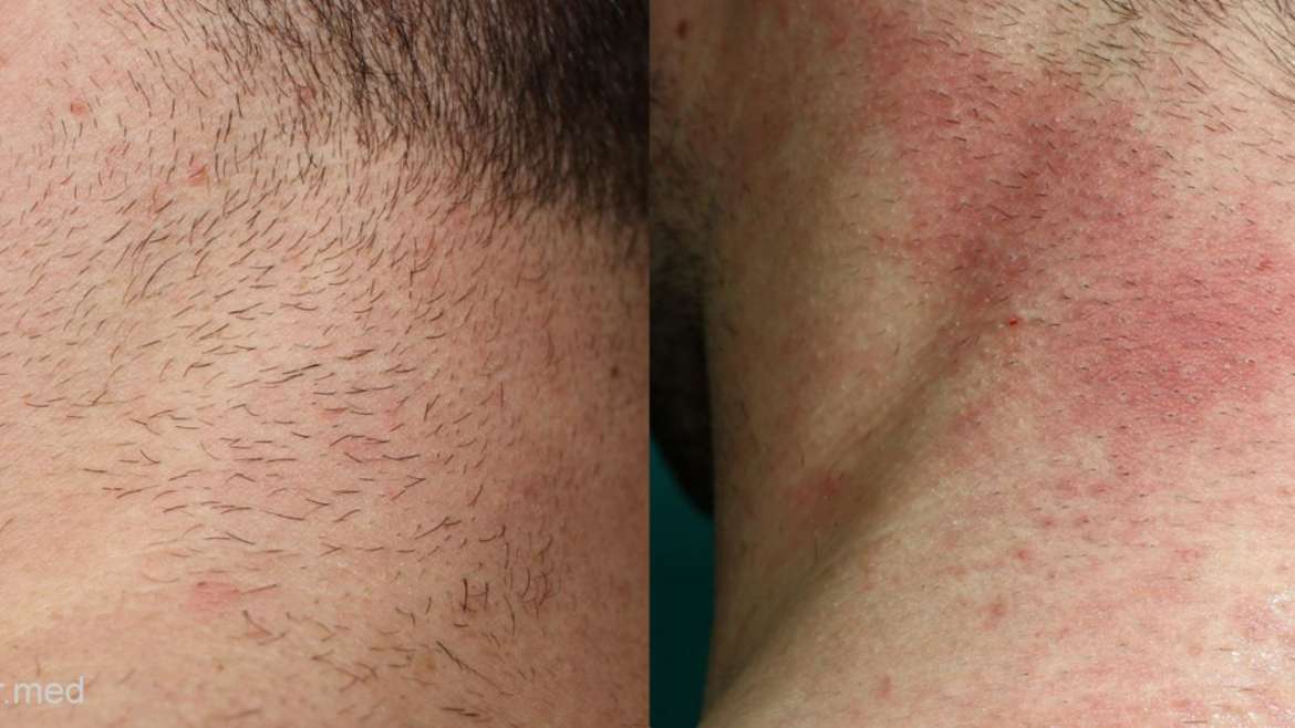Hair removal with ELOS™ technology and electrolysis