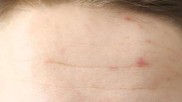 Kako gladimo brazgotine