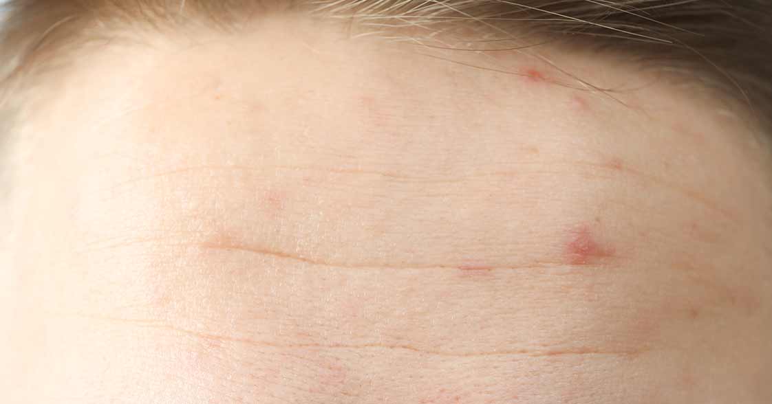 Kako gladimo brazgotine