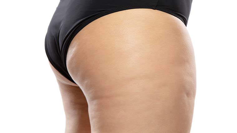 Cellulite