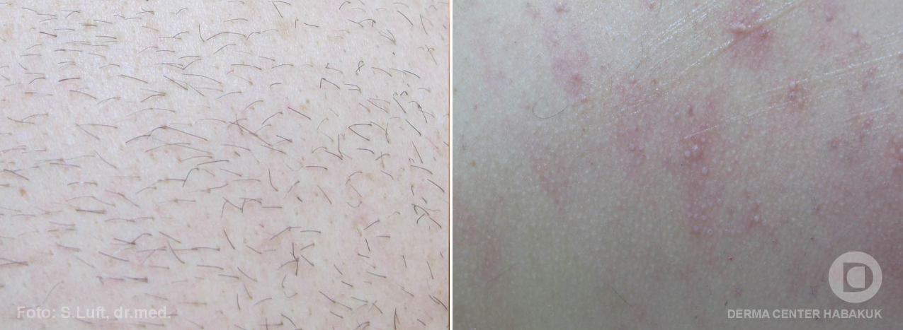 Naravnih pripravkov, s katerimi bi dosegli trajno zmanjšanje števila ali trajno odstranitev dlak ni. Odstranjevanje zato zaupajte dermatologu in sodobni medicinski tehnologiji.