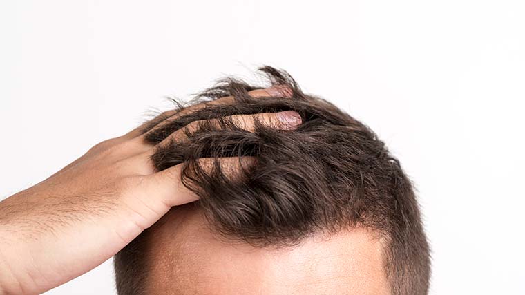 Hair loss