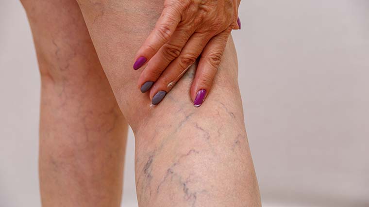 Varicose veins and capillaries in the legs