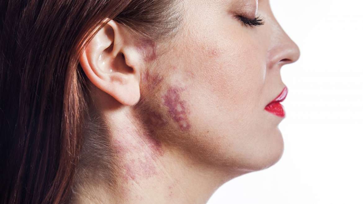 Treatment of port-wine stains (Nevus Flammeus)