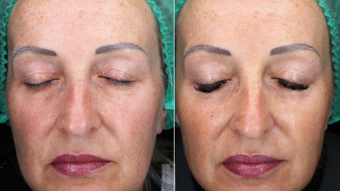 Radiofrequency technologies – Morpheus8 and FRACTORA