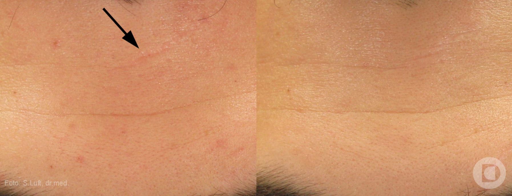 Scar smoothing, before and after the treatment