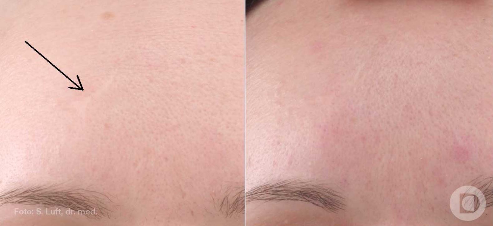 Scar smoothing, before and after the treatment
