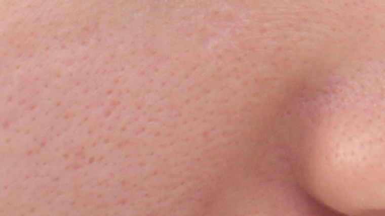 Enlarged pores