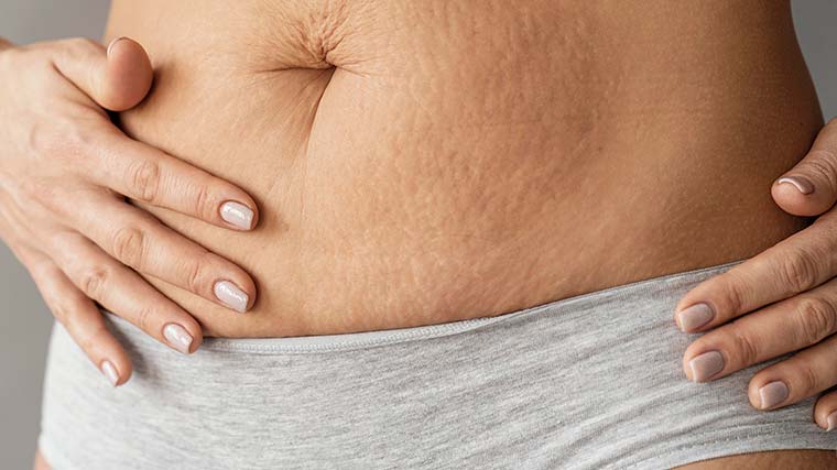 Striae/stretch marks