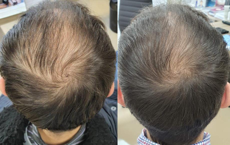 Hair loss treatment
