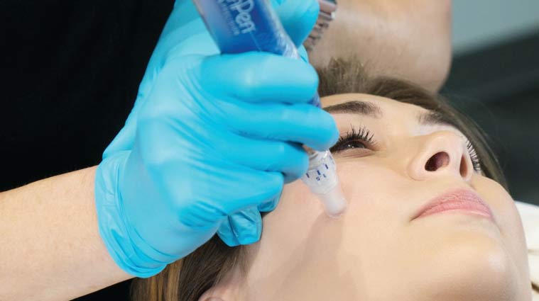 SkinPen® micronidling