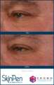 skinpen