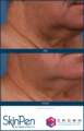 skinpen