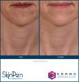 skinpen