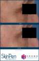skinpen5