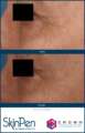 skinpen6
